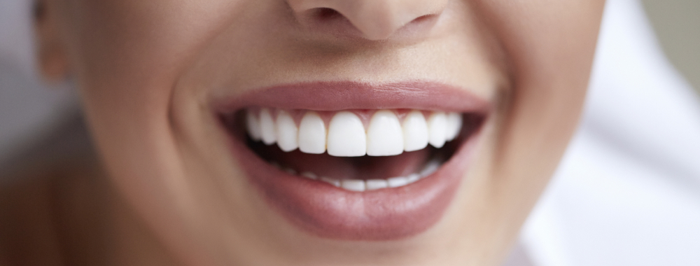 woman with veneers